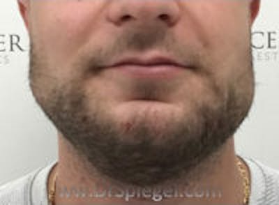 Mandible Jaw Filler Before & After Gallery - Patient 115525 - Image 2