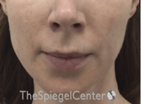 Mandible Jaw Filler Before & After Gallery - Patient 242447 - Image 1