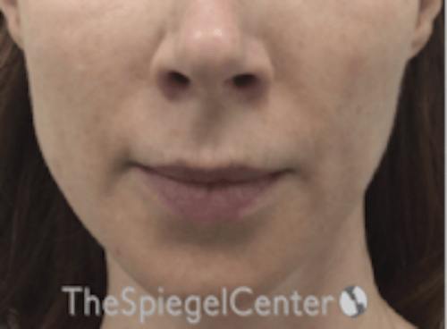 Mandible Jaw Filler Before & After Gallery - Patient 242447 - Image 1