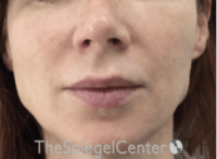 Mandible Jaw Filler Before & After Gallery - Patient 242447 - Image 2