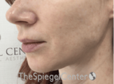 Mandible Jaw Filler Before & After Gallery - Patient 242447 - Image 4