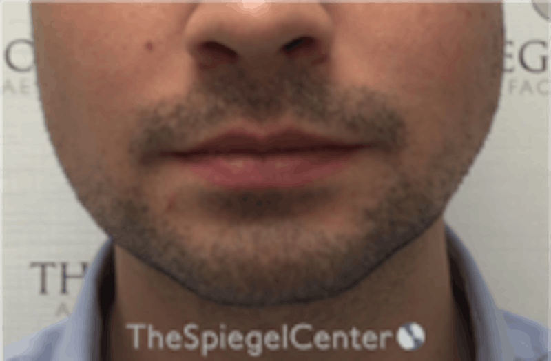 Mandible Jaw Filler Before & After Gallery - Patient 230787 - Image 1