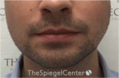 Mandible Jaw Filler Before & After Gallery - Patient 230787 - Image 2