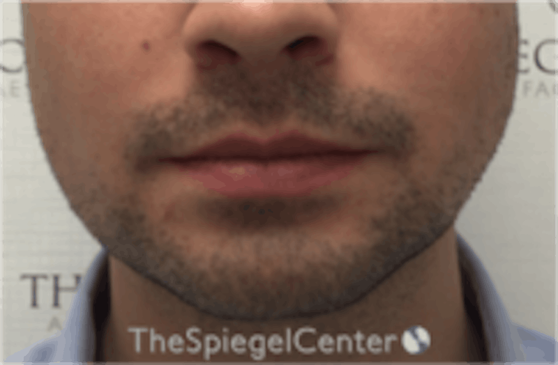 Mandible Jaw Filler Before & After Gallery - Patient 230787 - Image 2