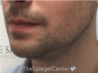 Mandible Jaw Filler Before & After Gallery - Patient 230787 - Image 3