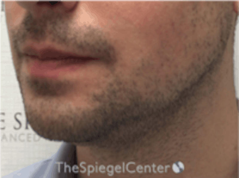 Mandible Jaw Filler Before & After Gallery - Patient 230787 - Image 3