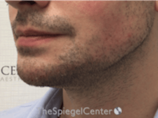Mandible Jaw Filler Before & After Gallery - Patient 230787 - Image 4