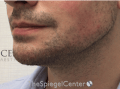 Mandible Jaw Filler Before & After Gallery - Patient 230787 - Image 4