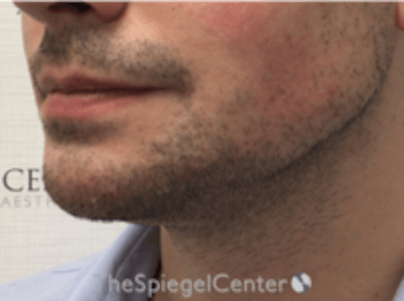 Mandible Jaw Filler Before & After Gallery - Patient 230787 - Image 4