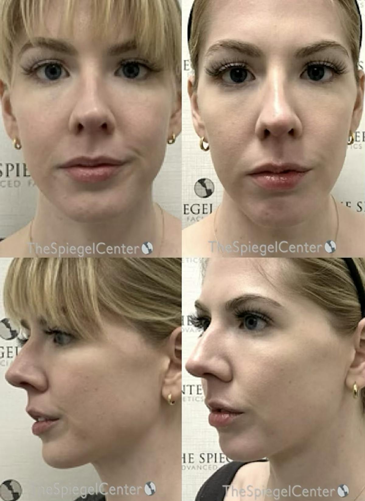 Masseter Botox Before & After Gallery - Patient 613921 - Image 1