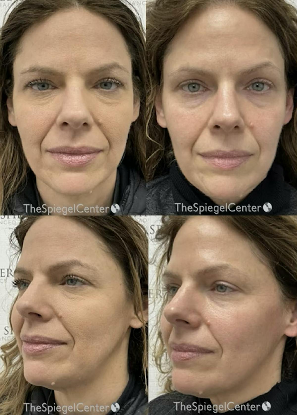 Masseter Botox Before & After Gallery - Patient 214002 - Image 1
