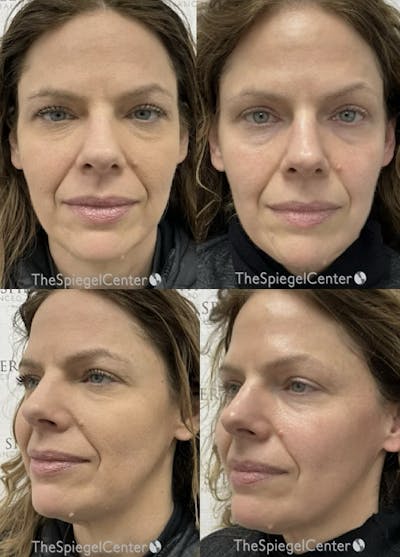 Masseter Botox Before & After Gallery - Patient 214002 - Image 1