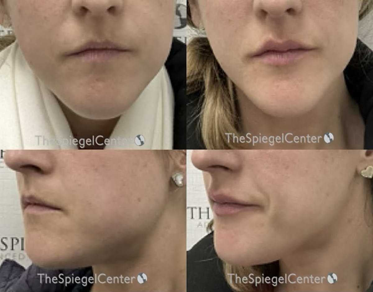 Masseter Botox Before & After Gallery - Patient 404246 - Image 1