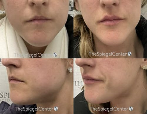 Masseter Botox Before & After Gallery - Patient 404246 - Image 1