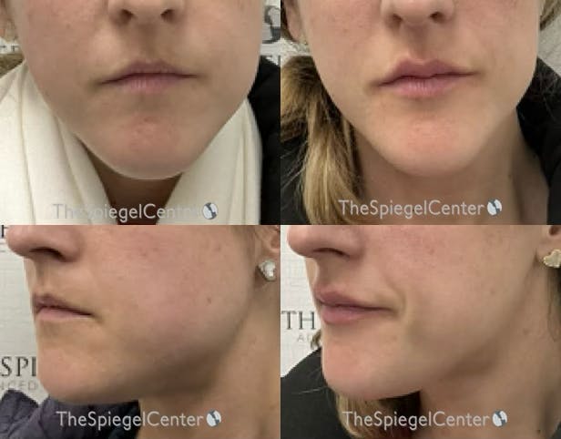 Masseter Botox Before & After Gallery - Patient 404246 - Image 1