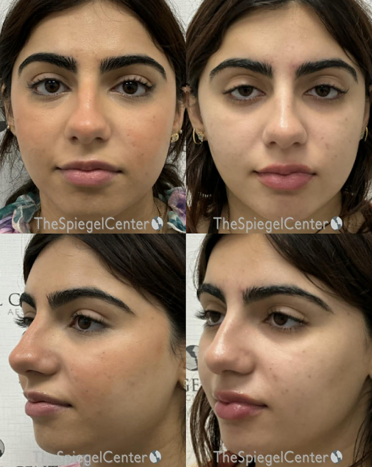 Masseter Botox Before & After Gallery - Patient 189780 - Image 1