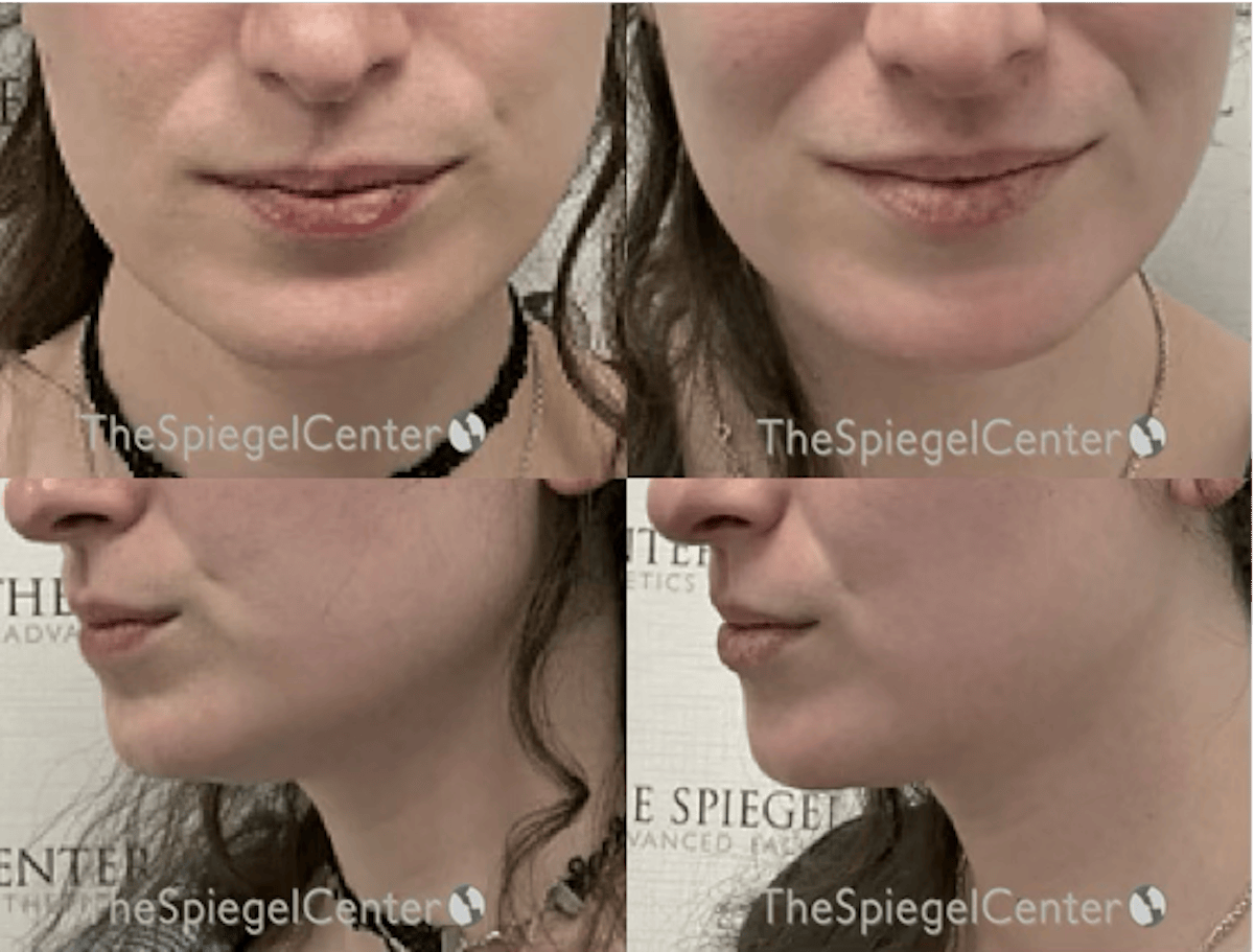 Masseter Botox Before & After Gallery - Patient 136451 - Image 1
