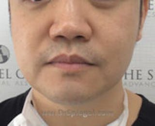 Masseter Botox Before & After Gallery - Patient 205594 - Image 2
