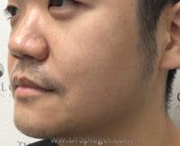 Masseter Botox Before & After Gallery - Patient 205594 - Image 3