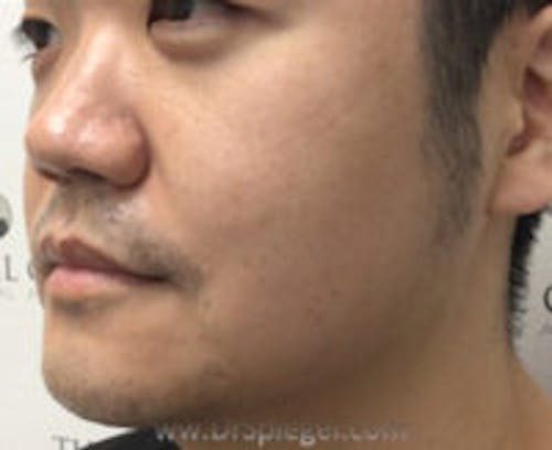 Masseter Botox Before & After Gallery - Patient 205594 - Image 3