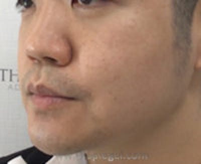 Masseter Botox Before & After Gallery - Patient 205594 - Image 4