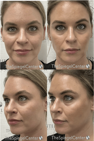 Masseter Botox Before & After Gallery - Patient 685439 - Image 1