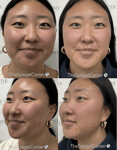 Masseter Botox Before & After Gallery - Patient 351376 - Image 1