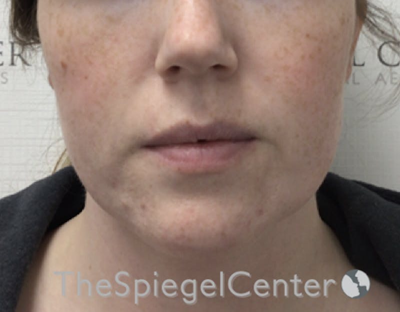 Masseter Botox Before & After Gallery - Patient 395067 - Image 1