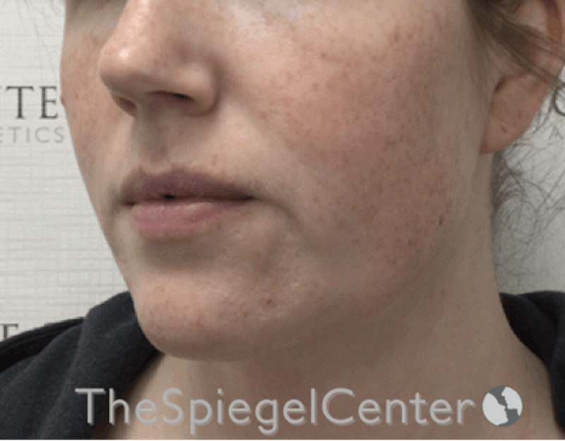 Masseter Botox Before & After Gallery - Patient 395067 - Image 3