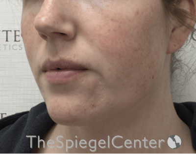 Masseter Botox Before & After Gallery - Patient 395067 - Image 3