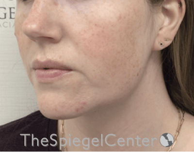 Masseter Botox Before & After Gallery - Patient 395067 - Image 4