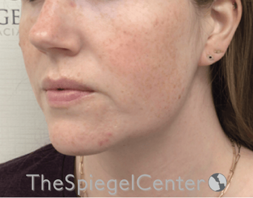 Masseter Botox Before & After Gallery - Patient 395067 - Image 4