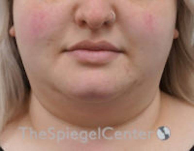 Masseter Botox Before & After Gallery - Patient 372206 - Image 1