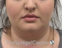 Masseter Botox Before & After Gallery - Patient 372206 - Image 2