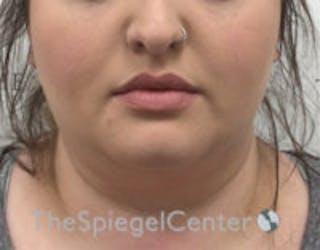 Masseter Botox Before & After Gallery - Patient 372206 - Image 2