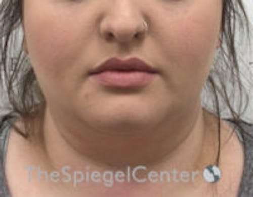 Masseter Botox Before & After Gallery - Patient 372206 - Image 2