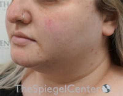 Masseter Botox Before & After Gallery - Patient 372206 - Image 3