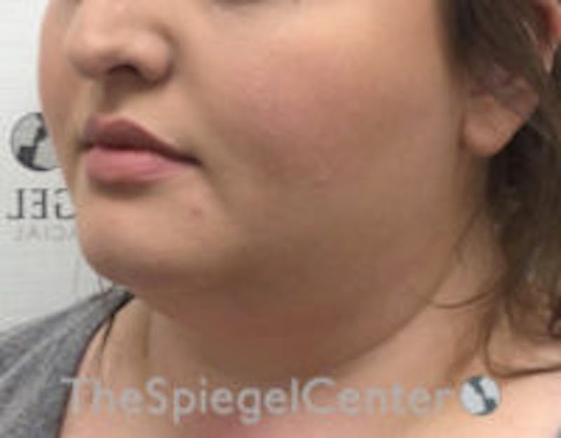 Masseter Botox Before & After Gallery - Patient 372206 - Image 4