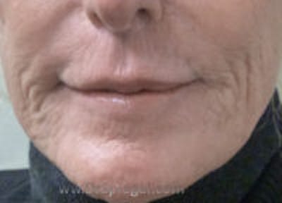 Microneedling Before & After Gallery - Patient 268533 - Image 1