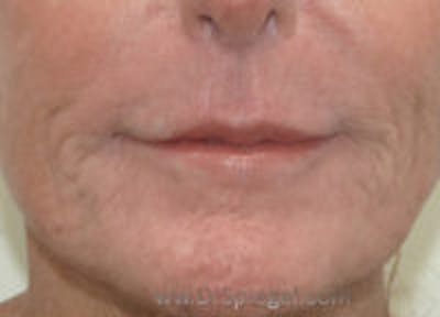 Microneedling Before & After Gallery - Patient 268533 - Image 2