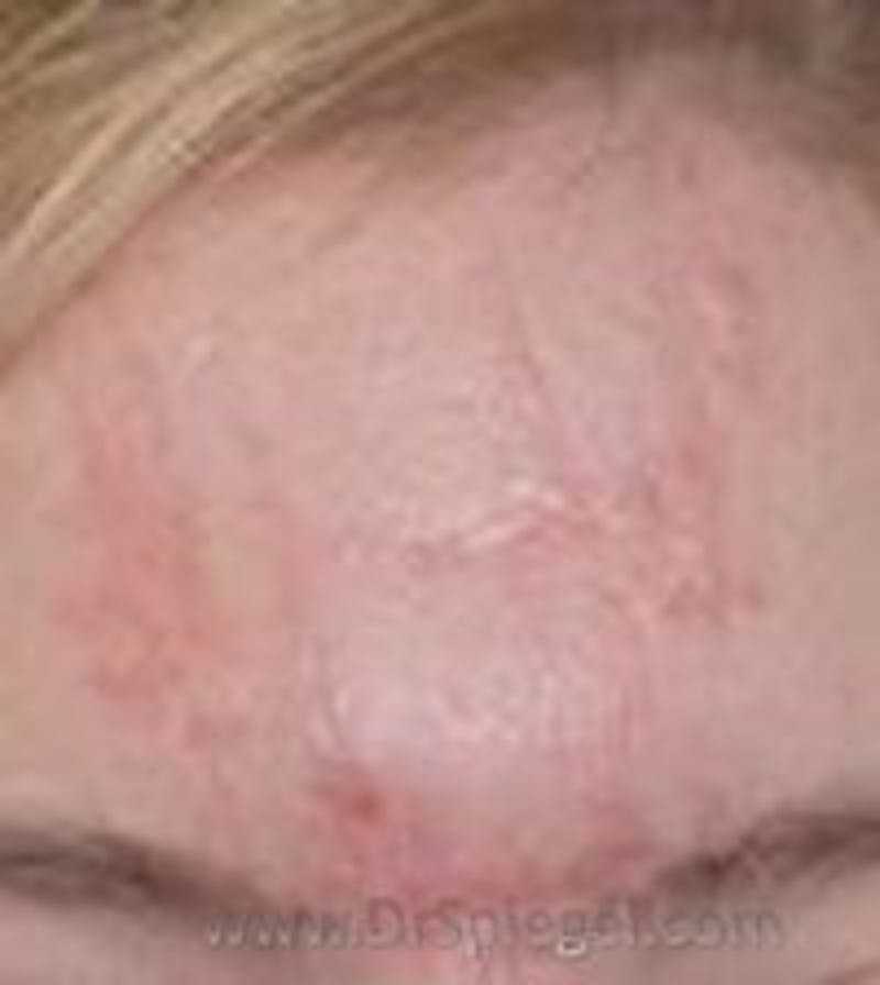 Microneedling Before & After Gallery - Patient 331630 - Image 1