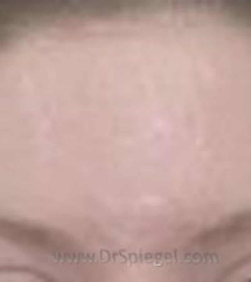 Microneedling Before & After Gallery - Patient 331630 - Image 2