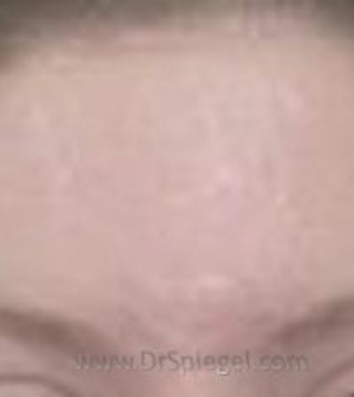 Microneedling Before & After Gallery - Patient 331630 - Image 2