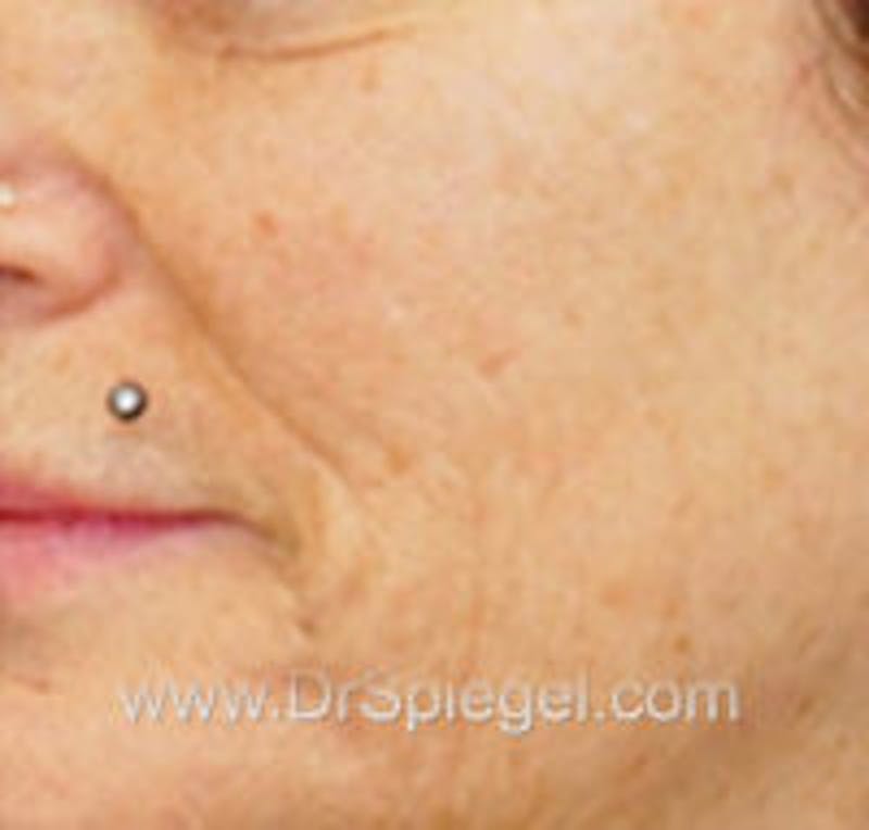 Microneedling Before & After Gallery - Patient 289603 - Image 1
