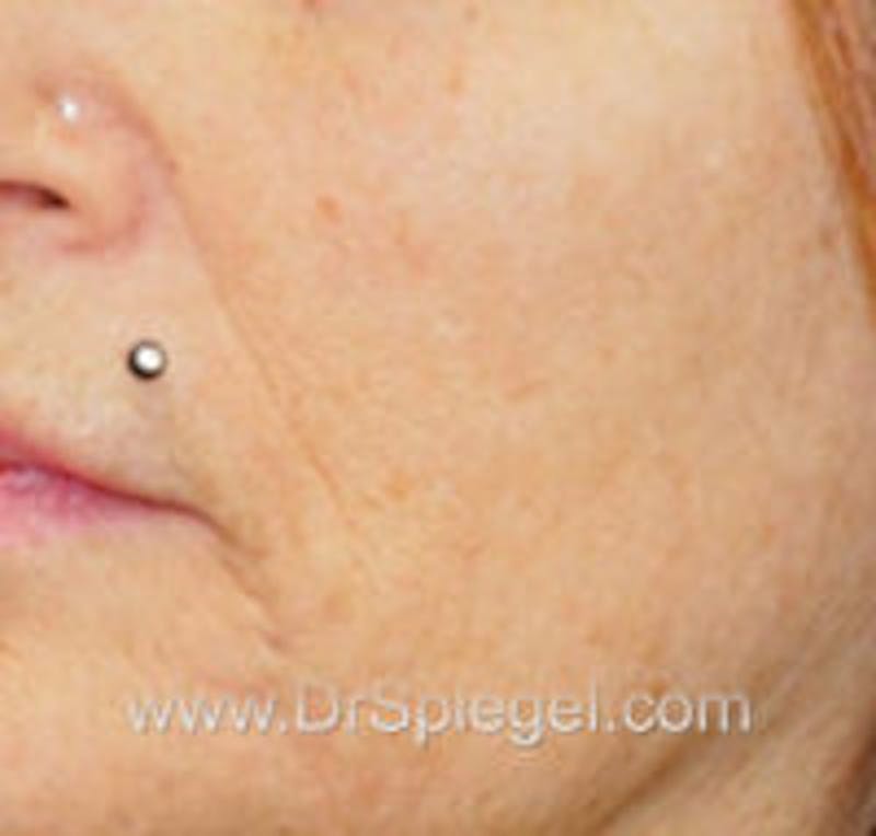 Microneedling Before & After Gallery - Patient 289603 - Image 2