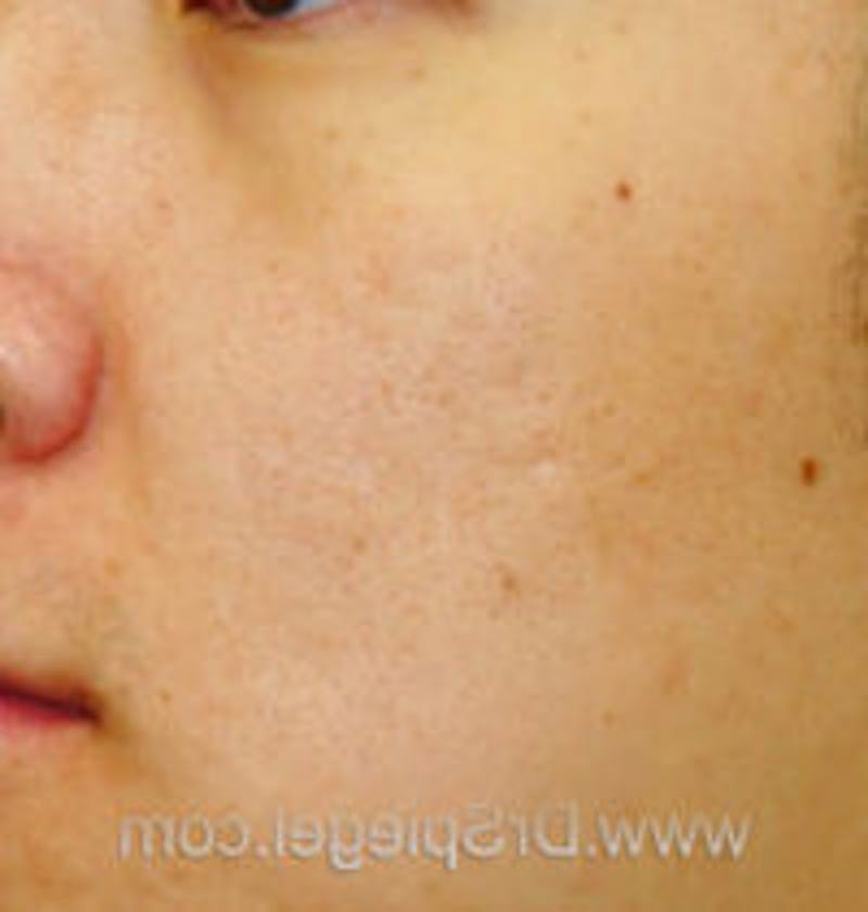 Microneedling Before & After Gallery - Patient 275489 - Image 1