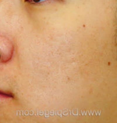 Microneedling Before & After Gallery - Patient 275489 - Image 1