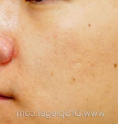 Microneedling Before & After Gallery - Patient 275489 - Image 2