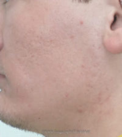 Microneedling Before & After Gallery - Patient 328056 - Image 2