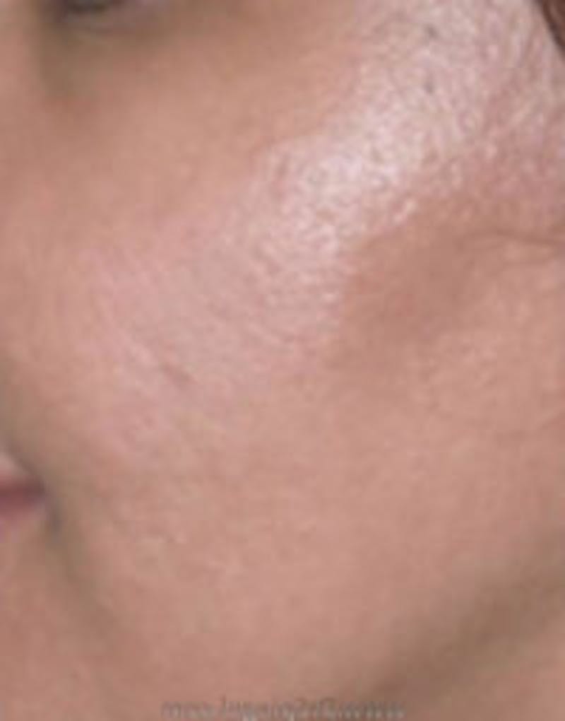 Microneedling Before & After Gallery - Patient 358028 - Image 1